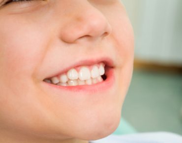 Nitrous Oxide and Oxygen Sedation
